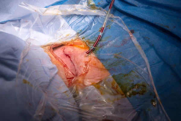 Operación quirúrgica en el quirófano — Foto de Stock