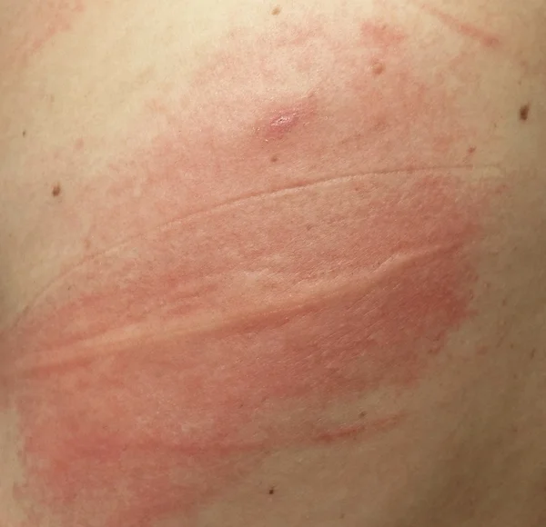 Rash on sensitive skin or skin problem with allergy rash