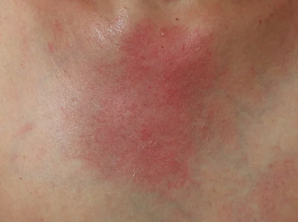 Erupção cutânea na pele sensível ou problema de pele com erupção cutânea alérgica — Fotografia de Stock