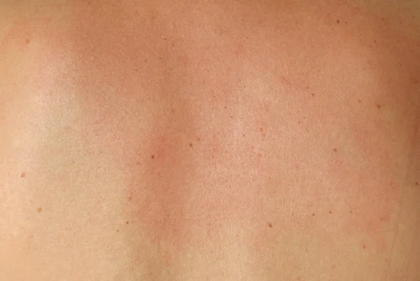 Текстура кожи человека — стоковое фото