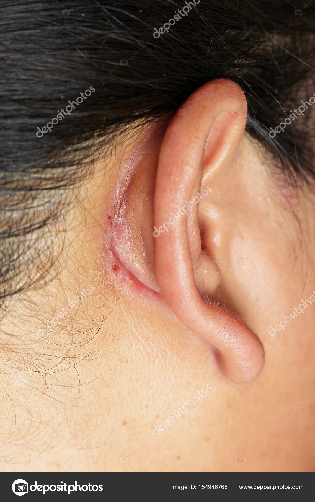 depositphotos_154946768-stock-photo-wound-behind-ear.jpg