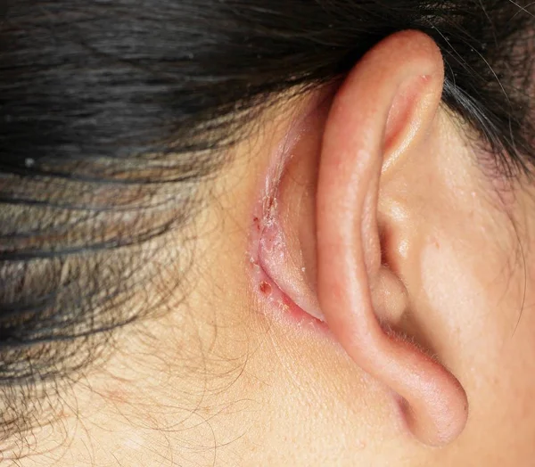 Wound behind ear — Stock Photo, Image
