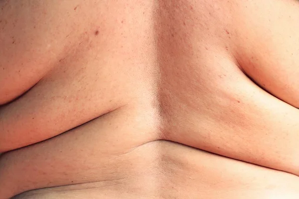 Надлишок жиру спини — стокове фото