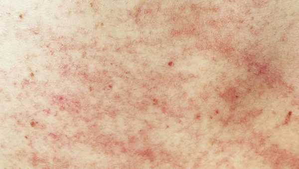 Rash on sensitive skin — Stock Photo, Image
