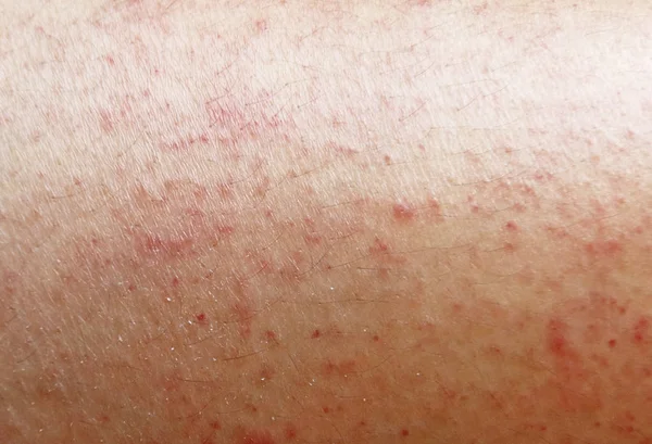 Erupção cutânea na pele sensível — Fotografia de Stock