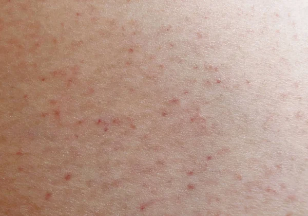 Rash on sensitive skin — Stock Photo, Image