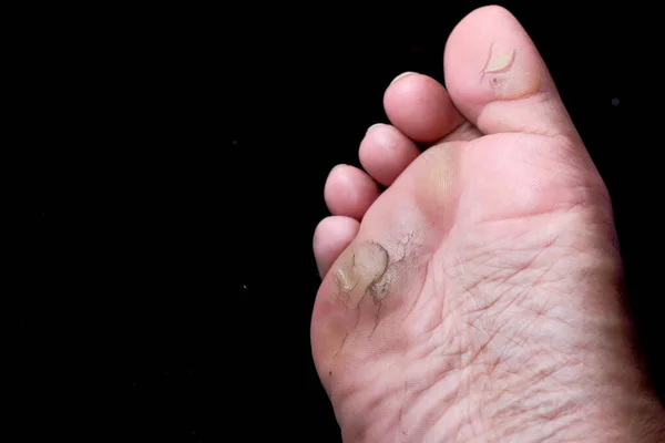 Feet Infection of the outer epidermis. Skin diseases, Foot Fungus — Stock Photo, Image