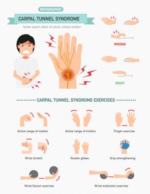 Karpal Tünel Sendromu Infographic, illüstrasyon.