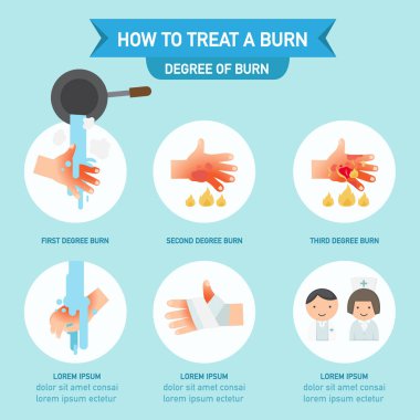 How to treat a burn infographic,vector illustration clipart
