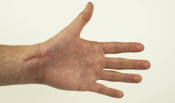 Hand with scar due to scaphoid bone fracture. White background. 