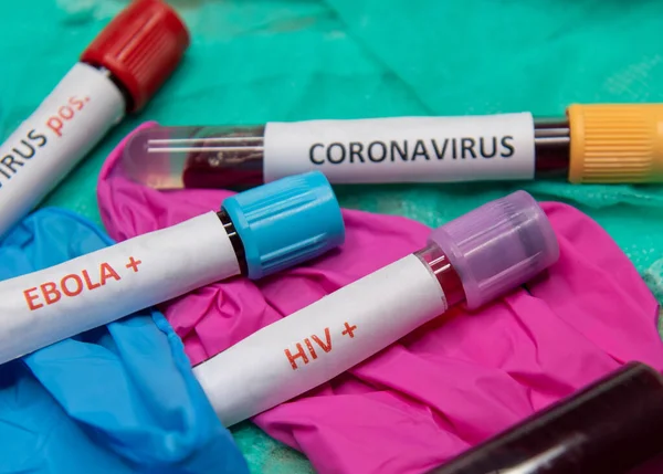 Hivの血液検査と陽性の検査とチューブ エボラは — ストック写真