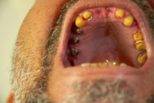 Human Mouth, Human Teeth, Metal, Stainless Steel, Dental Implant