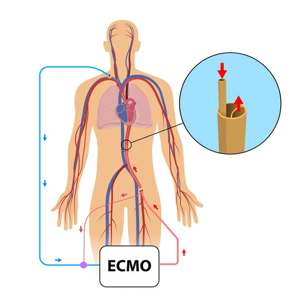 Extrakorporeal Membransyresättning Ecmo Intensivvårdsavdelningen — Stockfoto