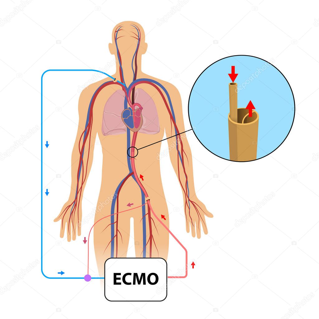Extracorporeal membrane oxygenation,ecmo in intensive care department 