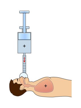 Pozitif basınçla yapay akciğer havalandırması prensibi.