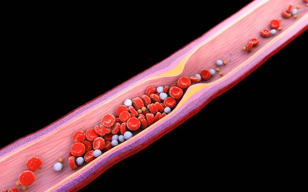 Illustration of blood cells with plaque buildup of cholesterol isolated black background Cholesterol plaque in artery