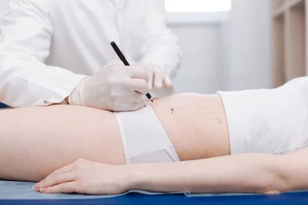 Médico preparando a los pacientes vientre para la liposucción — Foto de Stock
