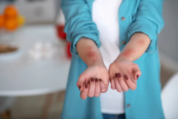 Allergic woman having an urticaria on her hands — 图库照片