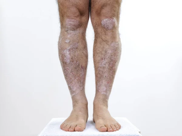 Adult Caucasian man suffering from psoriasis in the legs — Stock Photo, Image
