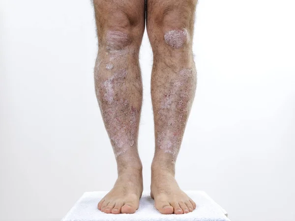 Vuxen kaukasiska man lider av psoriasis i benen — Stockfoto