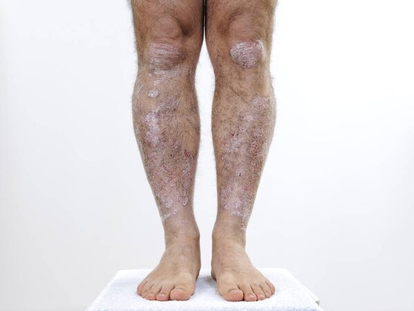 Adult Caucasian man suffering from psoriasis in the legs
