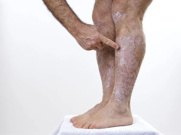 Erwachsener kaukasischer Mann leidet an Schuppenflechte in den Beinen — Stockfoto