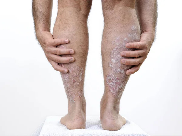 Pria Kaukasia dewasa menderita psoriasis di kaki — Stok Foto