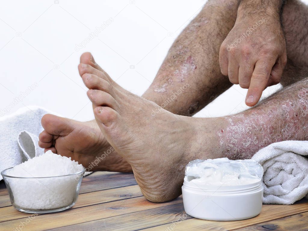 Adult Caucasian man suffering from psoriasis in the legs