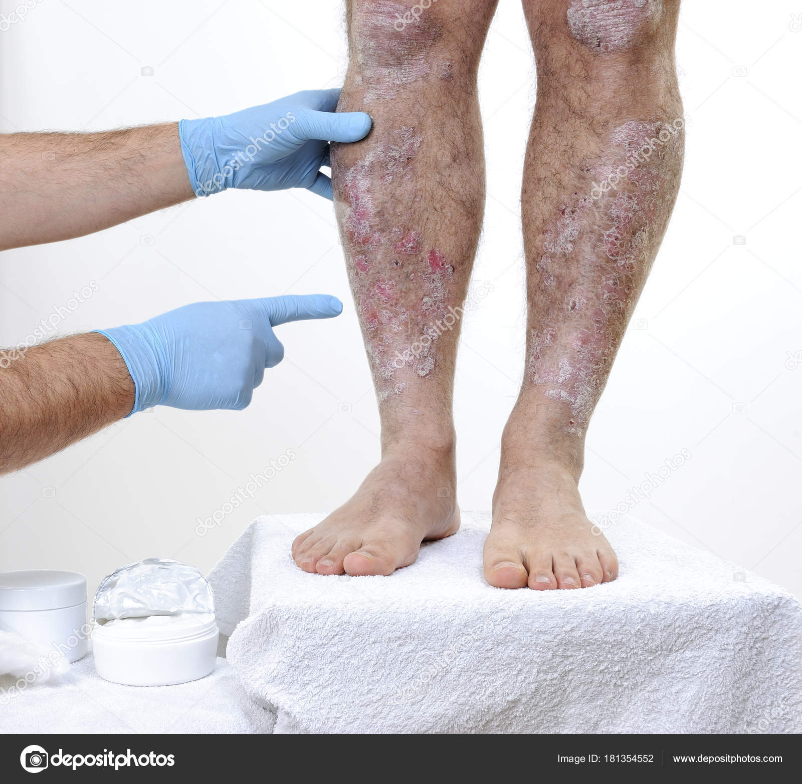 så meget Tage af eftertænksom Hudlægen besøger en voksen mand med psoriasis i benene — Stock-foto ©  francescomoufotografo #181354552