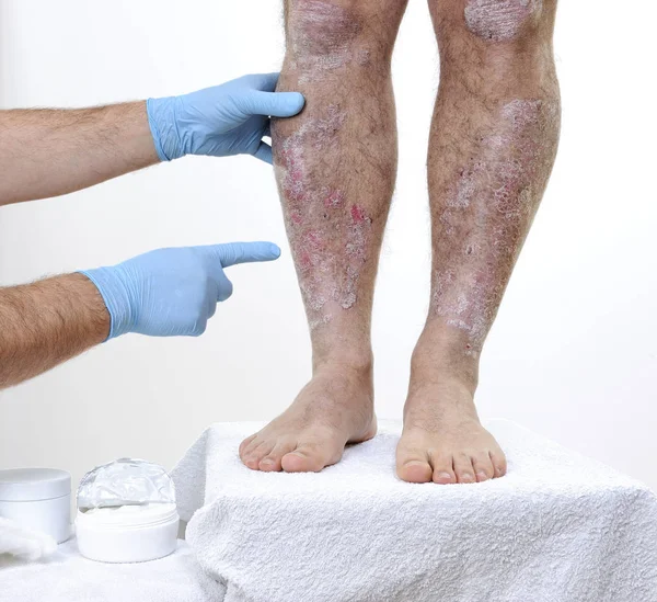 El dermatólogo visita a un hombre adulto con psoriasis en las piernas — Foto de Stock