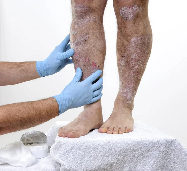 El dermatólogo visita a un hombre adulto con psoriasis en las piernas — Foto de Stock