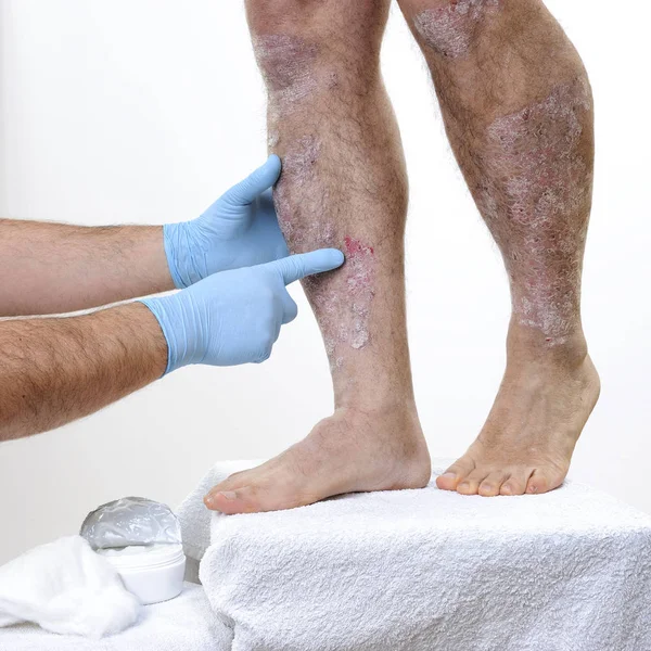 El dermatólogo visita a un hombre adulto con psoriasis en las piernas — Foto de Stock