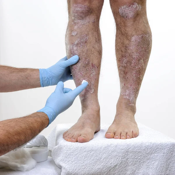 El dermatólogo cura a un hombre adulto que sufre de psoriasis en las piernas — Foto de Stock