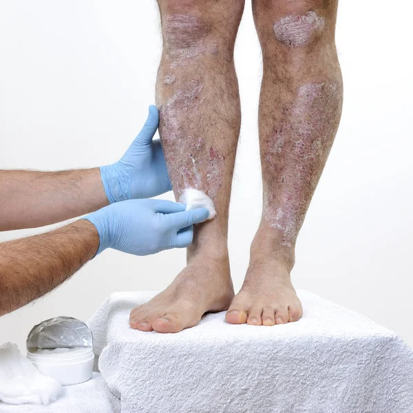 The dermatologist cure an adult man suffering from psoriasis on legs