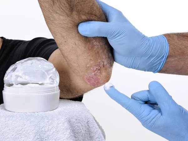 The dermatologist cure an adult man suffering from elbow psorias — Stock Photo, Image