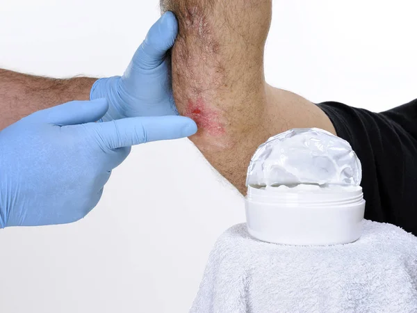 The dermatologist visits an adult man who suffers from psoriasis at the elbow — Stock Photo, Image