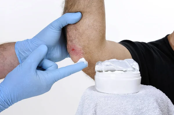 Der Hautarzt heilt einen erwachsenen Mann, der an Ellbogen-Schuppenflechte leidet — Stockfoto