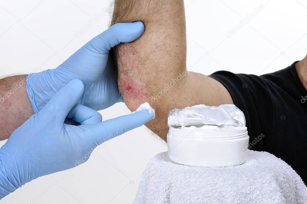 The dermatologist cure an adult man suffering from elbow psorias