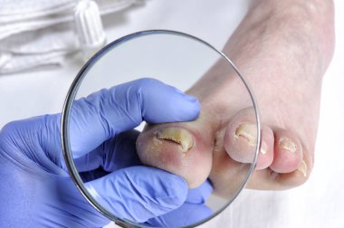 Onychomycosis, nail disease due to the action of pathogenic fungi. clipart