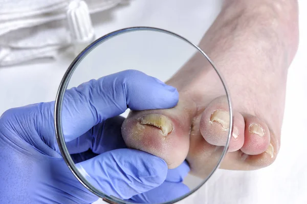 Onychomycosis, nail disease due to the action of pathogenic fungi. — Stock Photo, Image