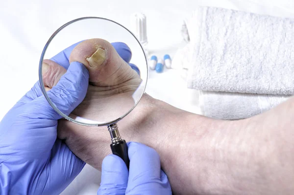 Onychomycosis, nail disease due to the action of pathogenic fungi. — Stock Photo, Image