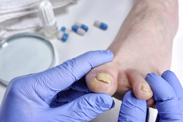 Онихомикоз - заболевание ногтей, вызванное действием патогенных микроорганизмов . — стоковое фото