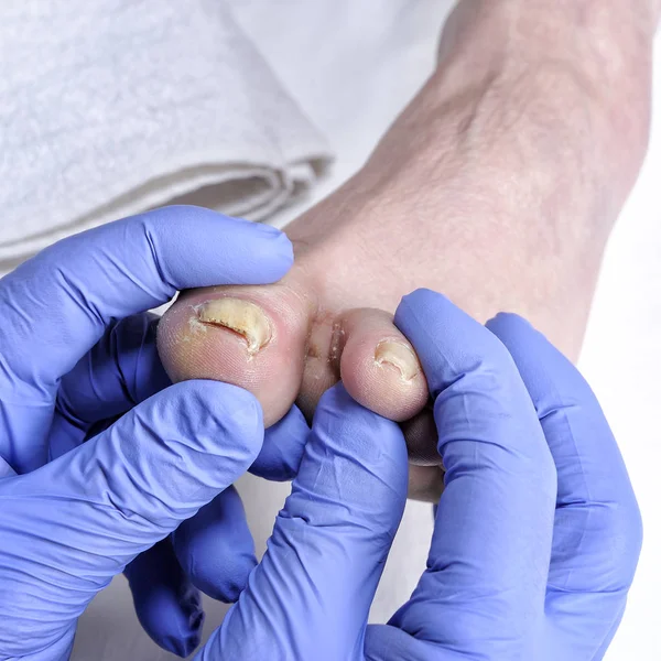 Onychomycosis, nail disease due to the action of pathogenic fungi. — Stock Photo, Image