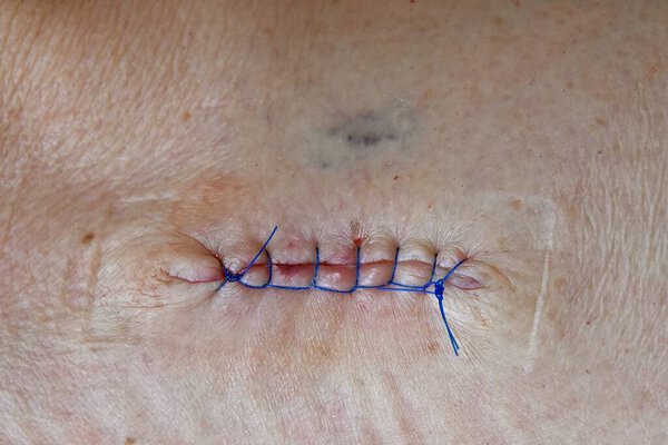 Предраковая опухоль удаляется из ноги, а шов закрывает рану.
.