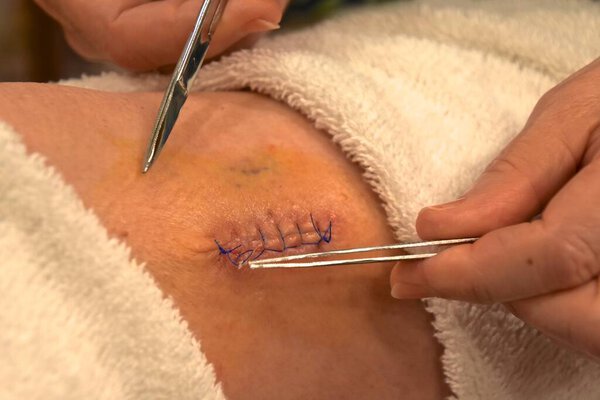 Пинцет используется для удаления шва из раны в ноге самим пациентом
