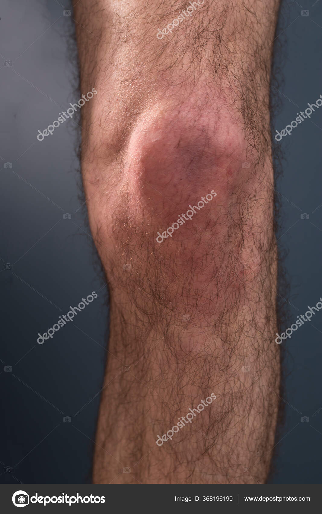 Hairy Knee Dark Background Medical Concept Pain Swollen Knee — Stock Photo  © elenarostunova 368196190