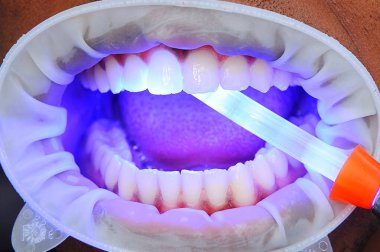 Diş dolgusu morötesi lamba