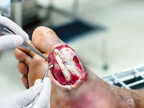 Diyabetik yaralar iyileşmek yavaş çoğu tıbbi yardım ve kontrolü, Diyabetik ayak enfeksiyonları gerektirir