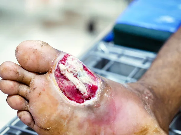 Infecciones del pie diabético, las heridas diabéticas a menudo son lentas para sanar requieren atención médica y monitoreo. —  Fotos de Stock