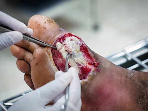 Las heridas diabéticas a menudo son lentas para sanar requieren atención médica y monitoreo, infecciones del pie diabético —  Fotos de Stock